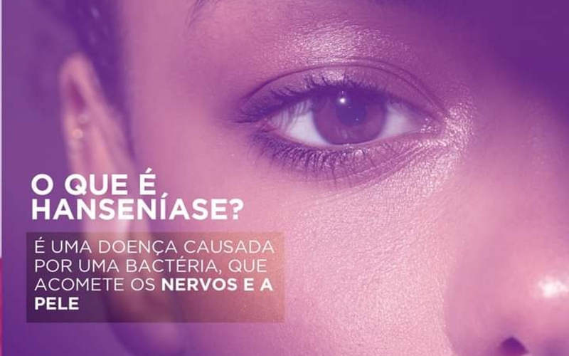 Em alusão ao ‘Janeiro Roxo’, Secretaria de Saúde faz conscientização sobre a hanseníase