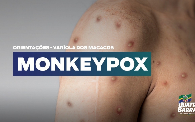 Até o momento livre de casos suspeitos, Quatro Barras alerta sobre varíola dos macacos